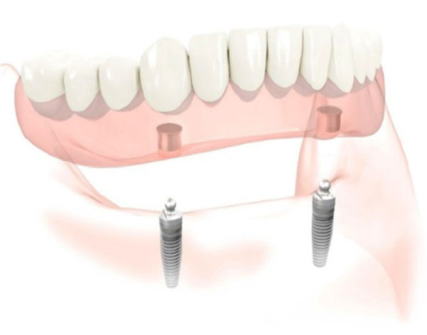 Implant Retained Dentures Clip On False Teeth NSOMS
